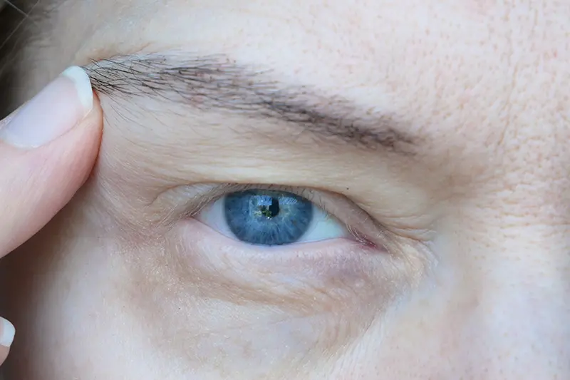 Closeup of eye with droopy eyelid